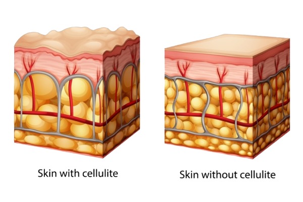 MANAGE THE CELLULITE